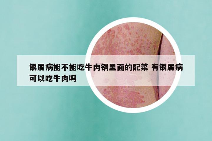 银屑病能不能吃牛肉锅里面的配菜 有银屑病可以吃牛肉吗
