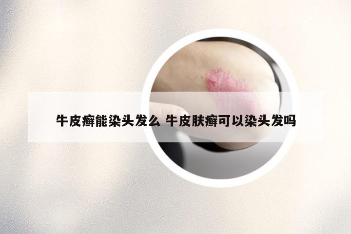 牛皮癣能染头发么 牛皮肤癣可以染头发吗