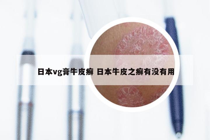 日本vg膏牛皮癣 日本牛皮之癣有没有用