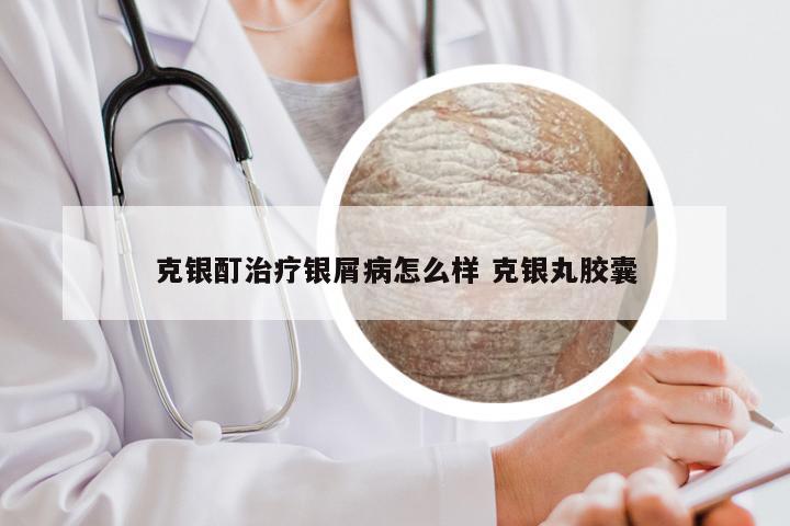 克银酊治疗银屑病怎么样 克银丸胶囊