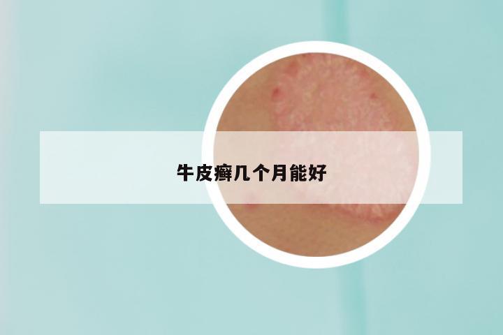 牛皮癣几个月能好