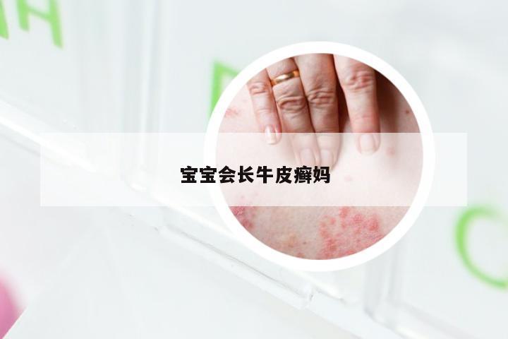 宝宝会长牛皮癣妈