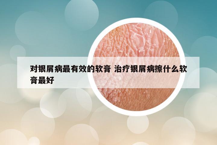 对银屑病最有效的软膏 治疗银屑病擦什么软膏最好