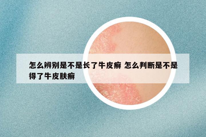 怎么辨别是不是长了牛皮癣 怎么判断是不是得了牛皮肤癣