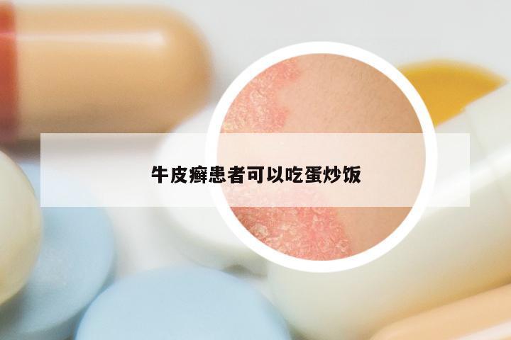 牛皮癣患者可以吃蛋炒饭