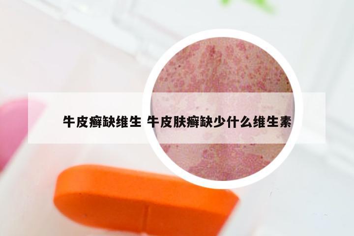 牛皮癣缺维生 牛皮肤癣缺少什么维生素