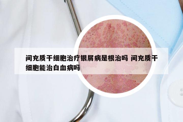 间充质干细胞治疗银屑病是根治吗 间充质干细胞能治白血病吗