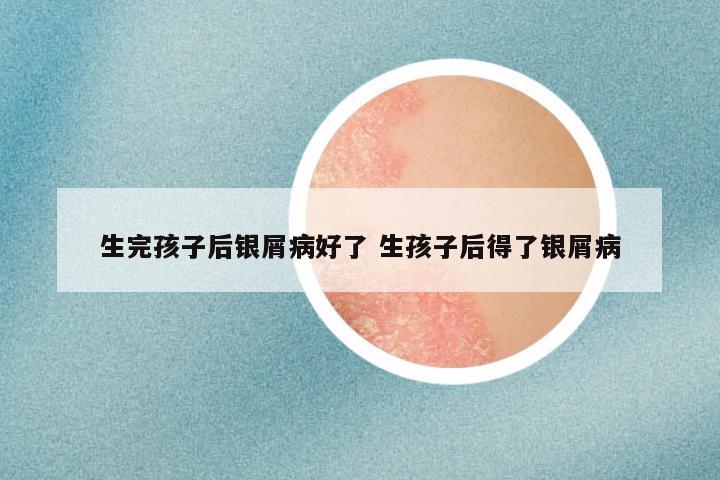 生完孩子后银屑病好了 生孩子后得了银屑病