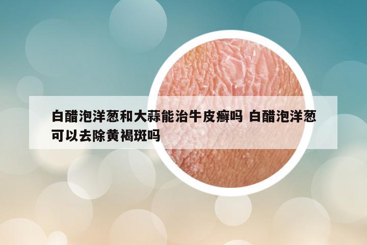 白醋泡洋葱和大蒜能治牛皮癣吗 白醋泡洋葱可以去除黄褐斑吗