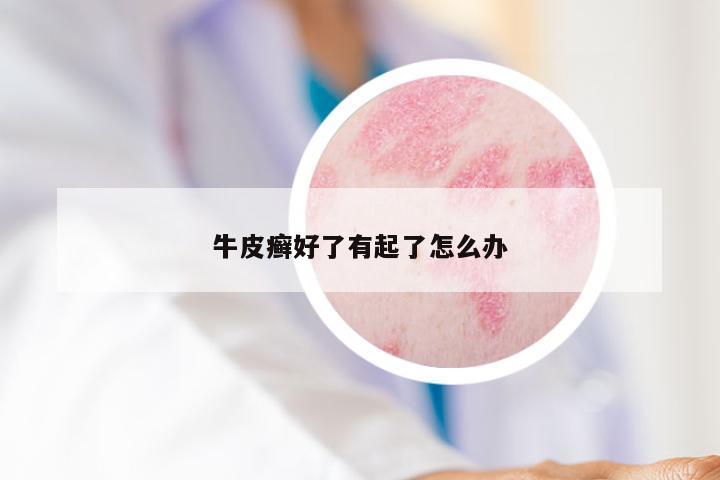 牛皮癣好了有起了怎么办