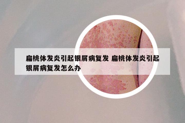 扁桃体发炎引起银屑病复发 扁桃体发炎引起银屑病复发怎么办
