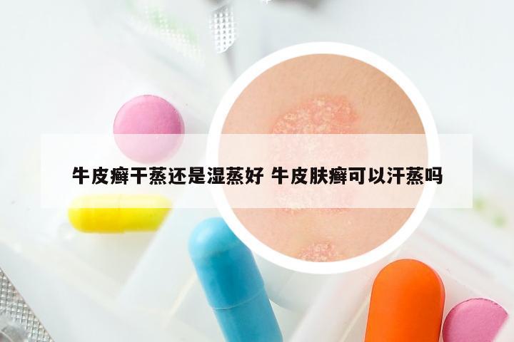 牛皮癣干蒸还是湿蒸好 牛皮肤癣可以汗蒸吗