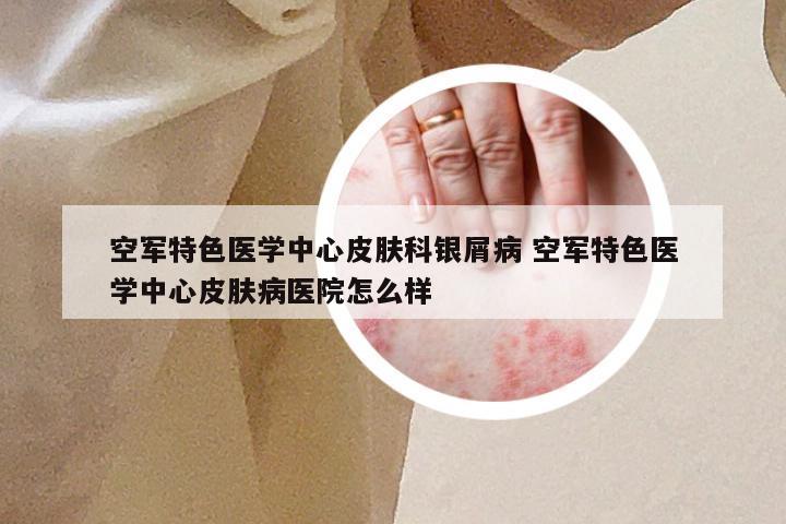 空军特色医学中心皮肤科银屑病 空军特色医学中心皮肤病医院怎么样