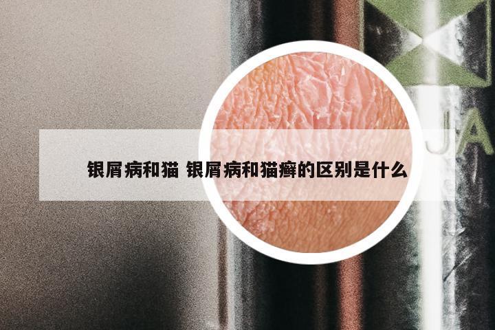 银屑病和猫 银屑病和猫癣的区别是什么
