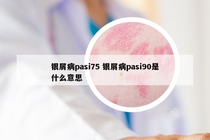 银屑病pasi75 银屑病pasi90是什么意思