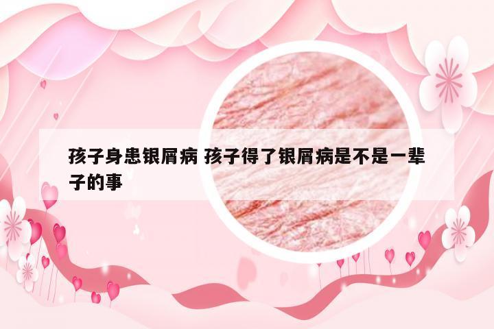 孩子身患银屑病 孩子得了银屑病是不是一辈子的事