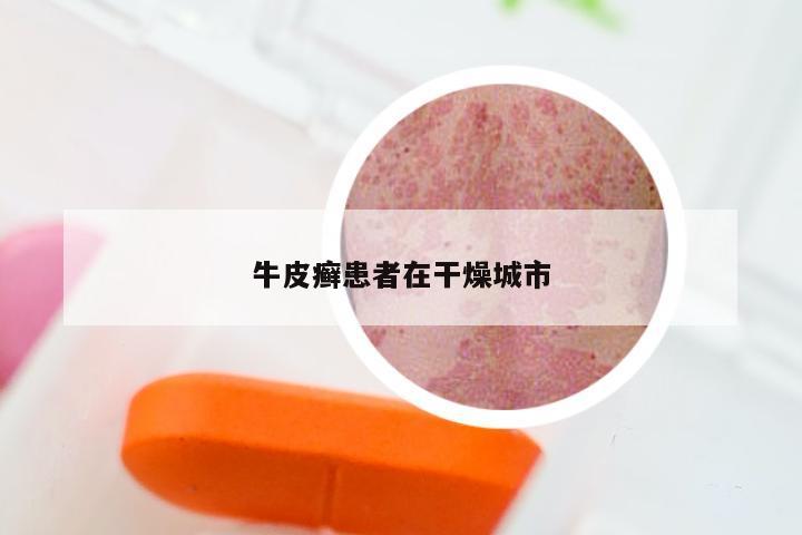 牛皮癣患者在干燥城市