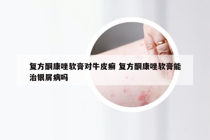 复方酮康唑软膏对牛皮癣 复方酮康唑软膏能治银屑病吗