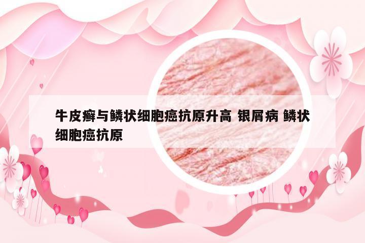 牛皮癣与鳞状细胞癌抗原升高 银屑病 鳞状细胞癌抗原