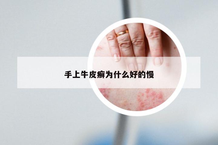 手上牛皮癣为什么好的慢