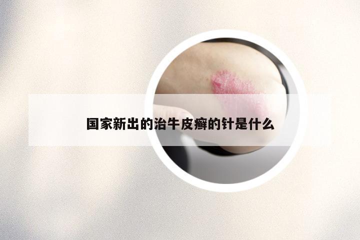 国家新出的治牛皮癣的针是什么