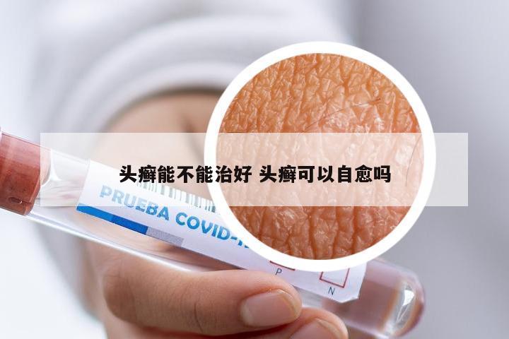 头癣能不能治好 头癣可以自愈吗