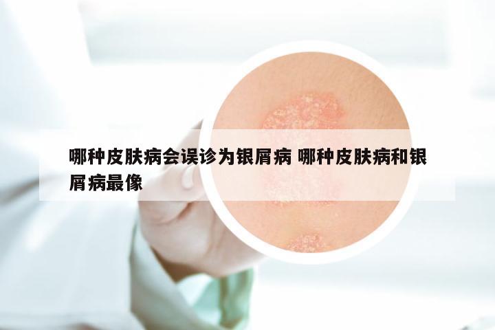 哪种皮肤病会误诊为银屑病 哪种皮肤病和银屑病最像