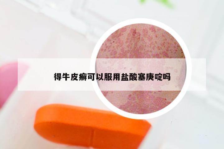 得牛皮癣可以服用盐酸塞庚啶吗