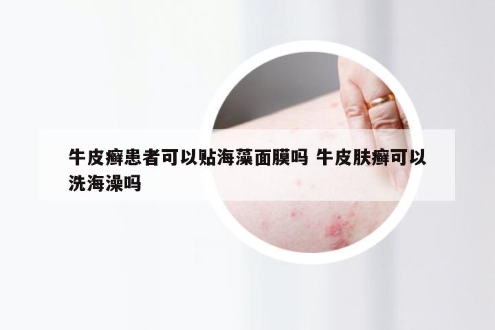 牛皮癣患者可以贴海藻面膜吗 牛皮肤癣可以洗海澡吗