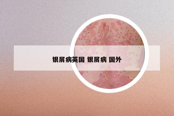 银屑病英国 银屑病 国外