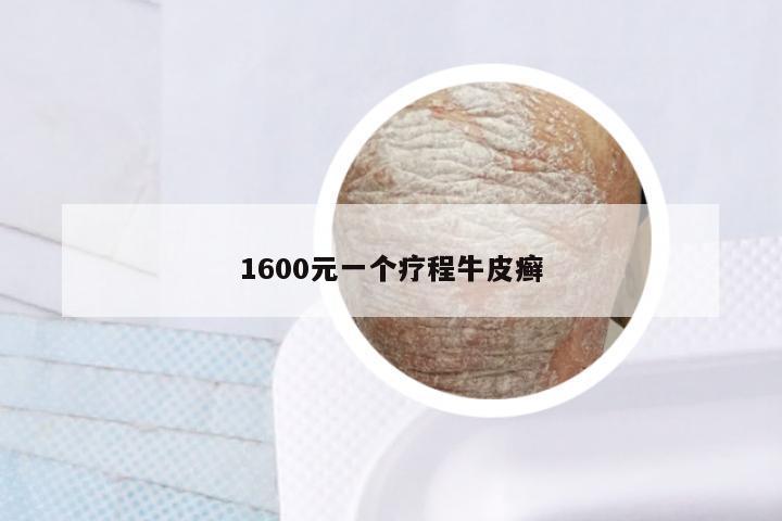 1600元一个疗程牛皮癣
