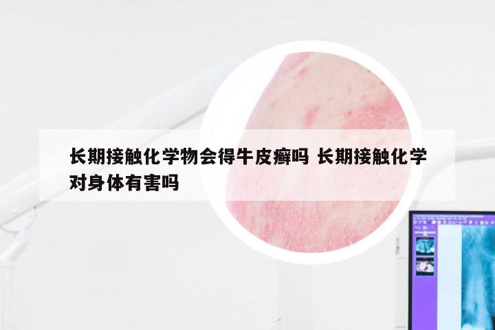 长期接触化学物会得牛皮癣吗 长期接触化学对身体有害吗