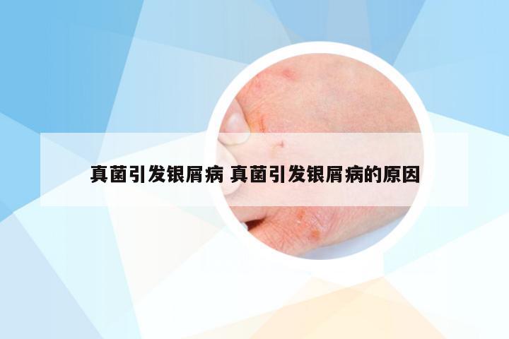 真菌引发银屑病 真菌引发银屑病的原因