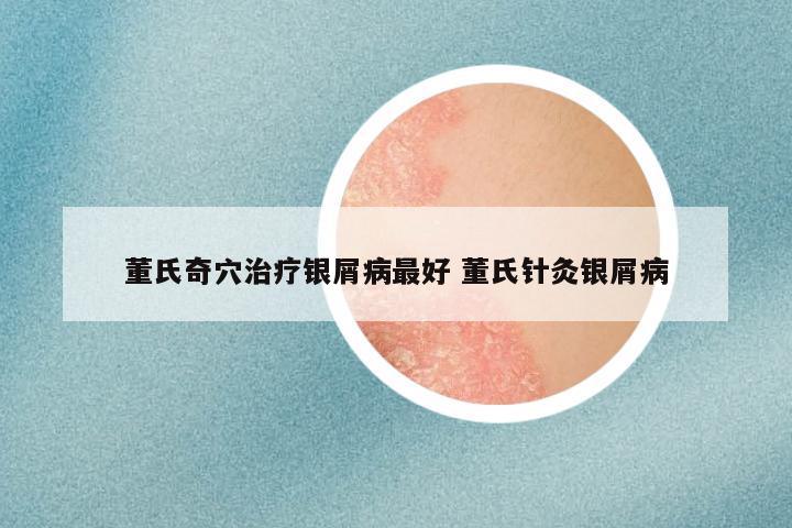 董氏奇穴治疗银屑病最好 董氏针灸银屑病