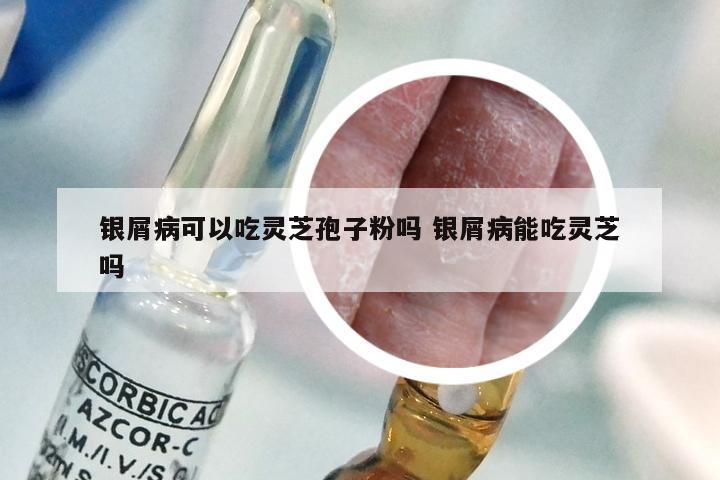 银屑病可以吃灵芝孢子粉吗 银屑病能吃灵芝吗