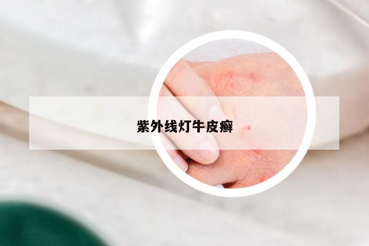 紫外线灯牛皮癣