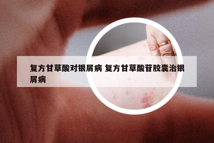 复方甘草酸对银屑病 复方甘草酸苷胶囊治银屑病