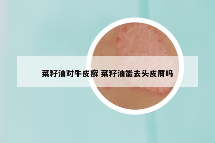 菜籽油对牛皮癣 菜籽油能去头皮屑吗