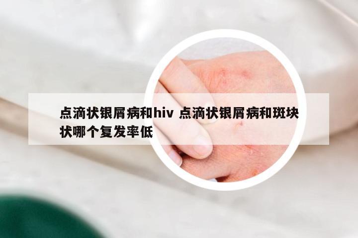 点滴状银屑病和hiv 点滴状银屑病和斑块状哪个复发率低