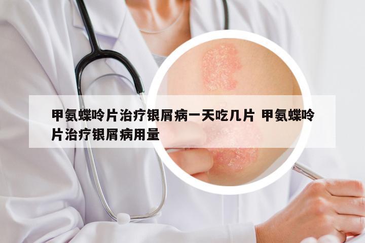 甲氨蝶呤片治疗银屑病一天吃几片 甲氨蝶呤片治疗银屑病用量