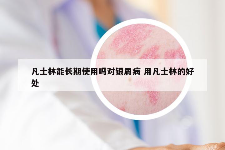 凡士林能长期使用吗对银屑病 用凡士林的好处