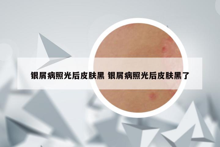 银屑病照光后皮肤黑 银屑病照光后皮肤黑了