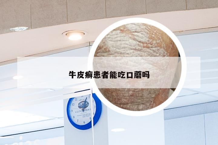 牛皮癣患者能吃口蘑吗
