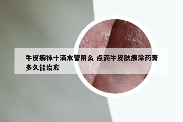 牛皮癣抹十滴水管用么 点滴牛皮肤癣涂药膏多久能治愈