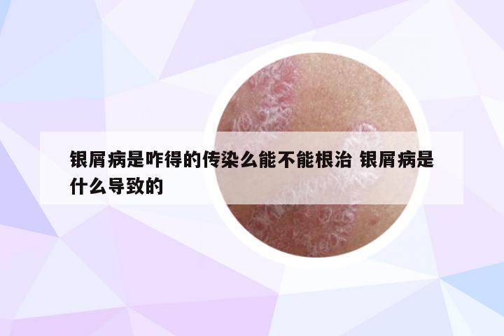 银屑病是咋得的传染么能不能根治 银屑病是什么导致的