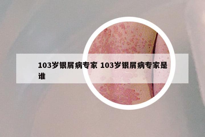 103岁银屑病专家 103岁银屑病专家是谁
