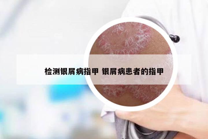 检测银屑病指甲 银屑病患者的指甲