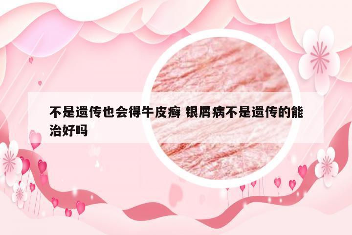 不是遗传也会得牛皮癣 银屑病不是遗传的能治好吗
