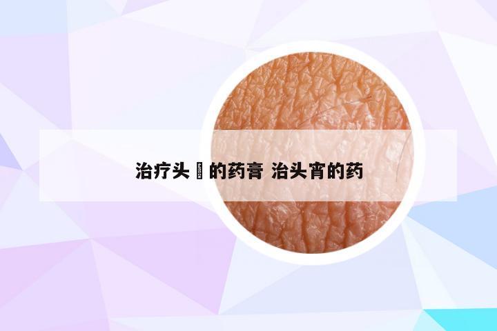 治疗头廯的药膏 治头宵的药