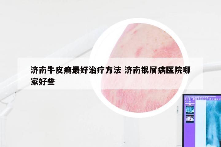济南牛皮癣最好治疗方法 济南银屑病医院哪家好些